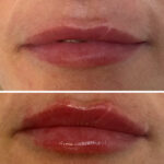 Lip Fillers and injections St. John's