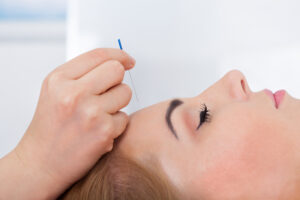 acupuncture - facial treatment