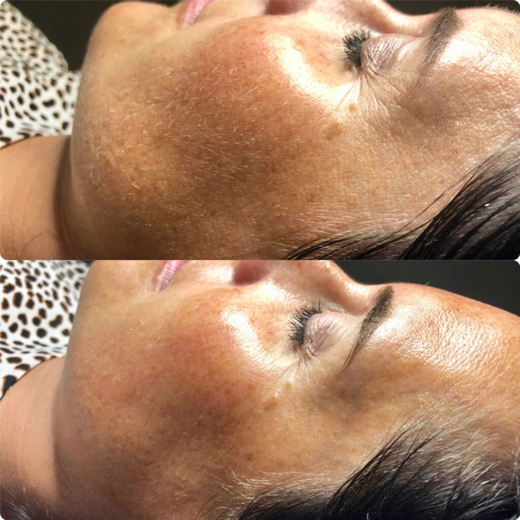 dermaplaning - before and after