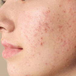 trouble with acne - try these bundles!